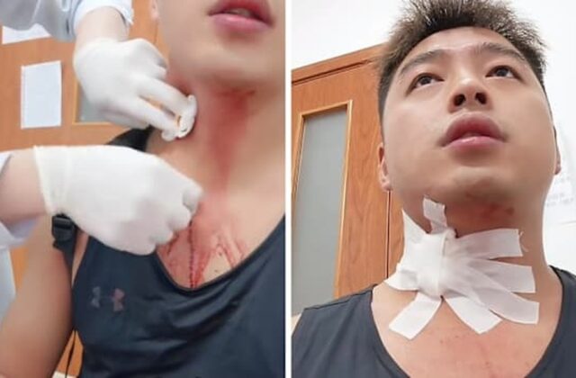 Người Đàn Ông Đã Gặp Nguy Hiểm Nghiêm Trọng Do Muỗi Đốt